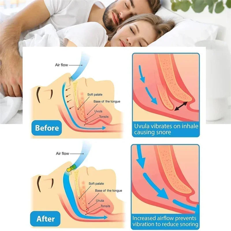 SilentEase Anti-Snore Nose Clip