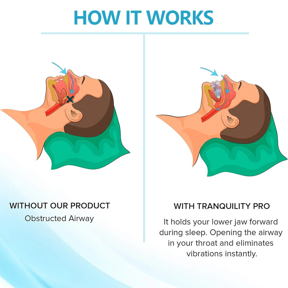 SilentGuard: Anti-Snoring & Bruxism Mouthpiece